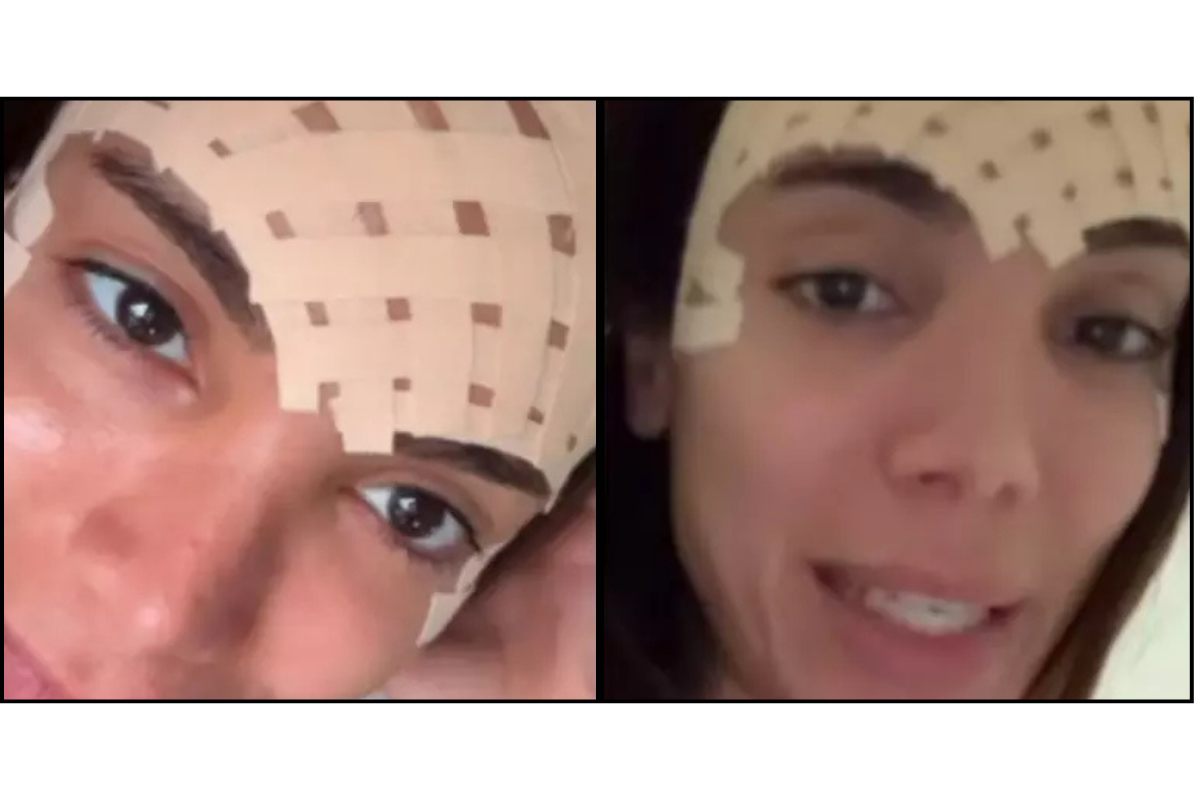 Anitta showcasing her glowing skin post-treatment